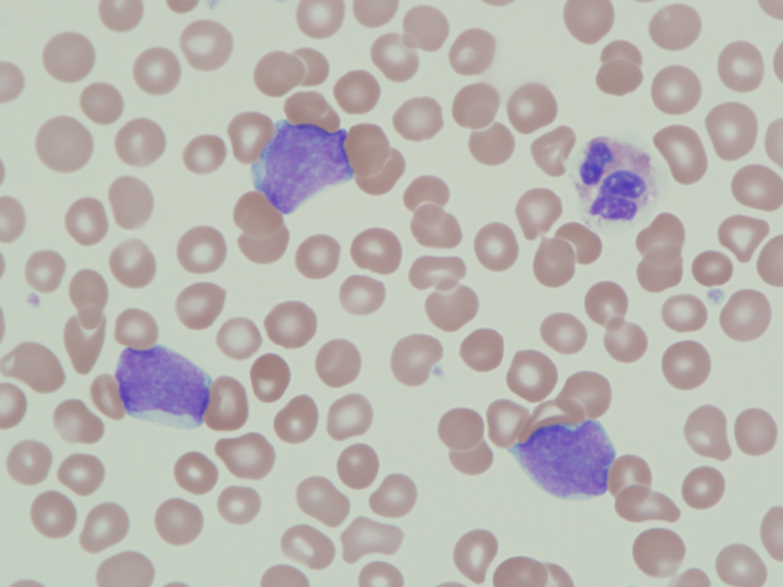 Figure 1a: Peripheral blood smear highlighting blast morphology (1000x magnification).